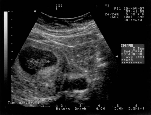First Ultrasound of our baby